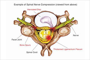 decompression nerve