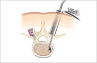 minimally invasive spine surgery